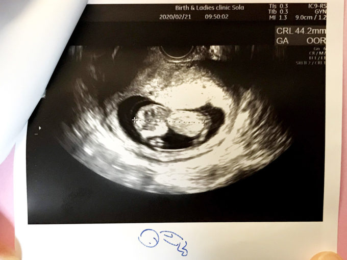 妊娠11周目の初検診エコー写真